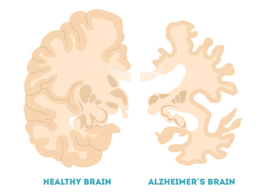 Alzheimer's brain