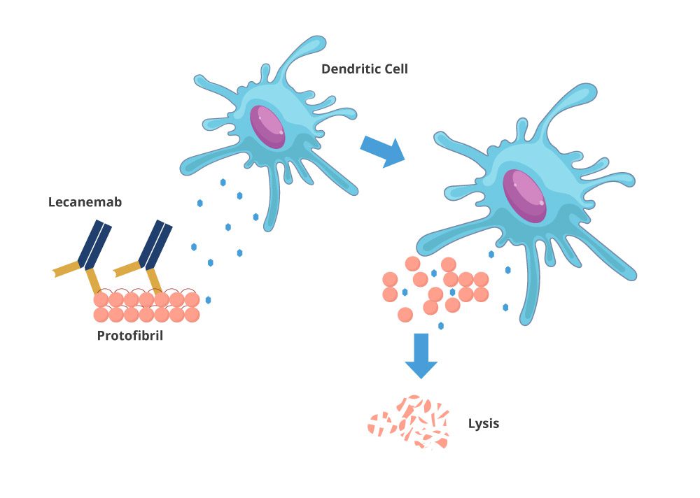 Lecanemab and dendritic cells