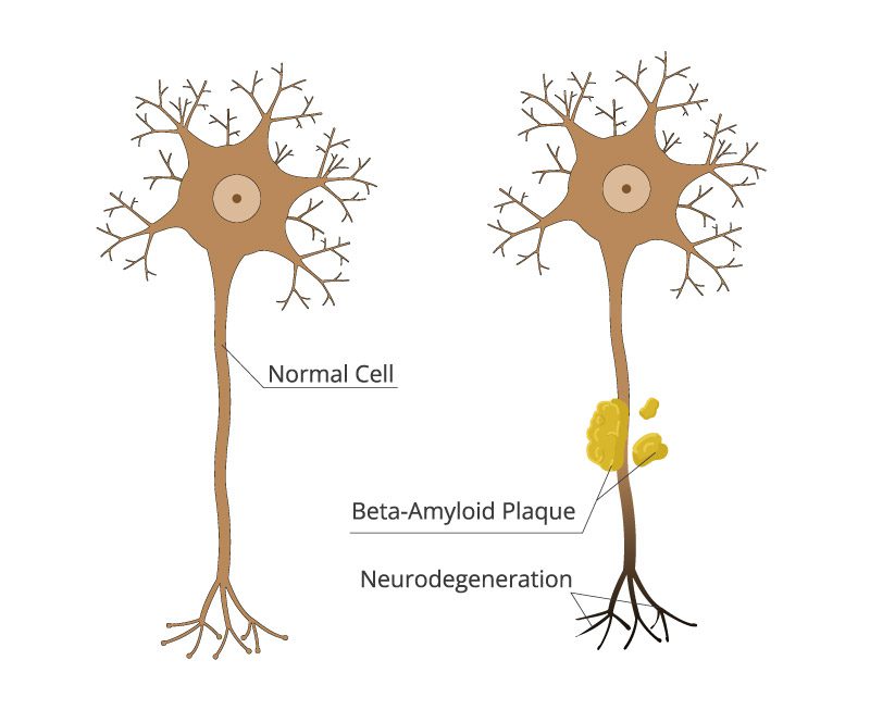 Normal and Alzheimer's cell